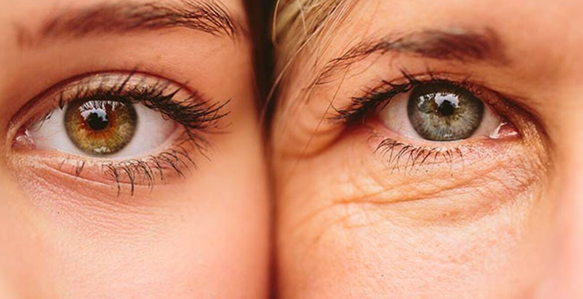 Các dấu hiệu bên ngoài của lão hóa da quanh mắt ở hai phụ nữ ở các độ tuổi khác nhau