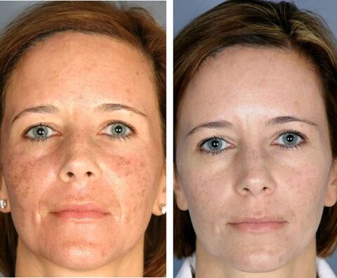 Trước và sau khi nhiệt phân khuôn mặt
