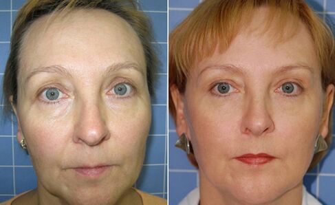 Trước và sau khi trẻ hóa da mặt bằng laser phân đoạn