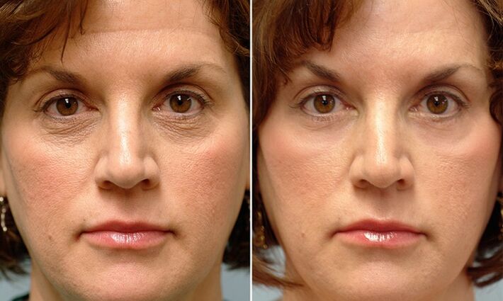khuôn mặt trước và sau khi trẻ hóa phân đoạn bằng laser